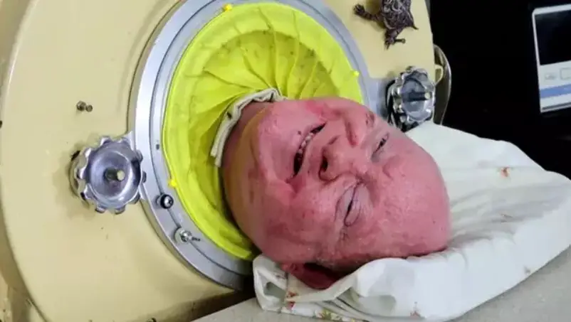 Man Who Famously Lived In Iron Lung for Over 70 Years Has Died at Age 78