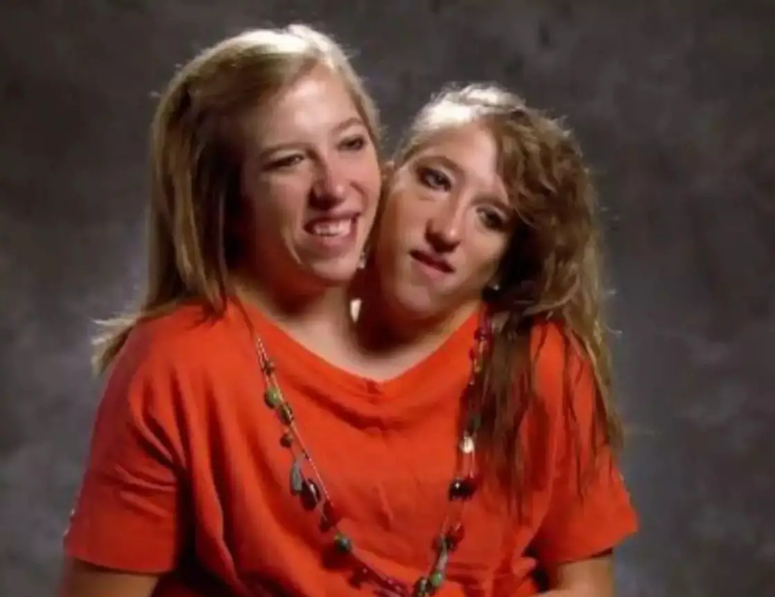 Conjoined Twins Abby and Brittany Hensel Only Get Paid One Salary